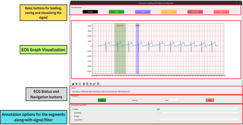 Figure 5: ECG filtration performed by TeleCardio