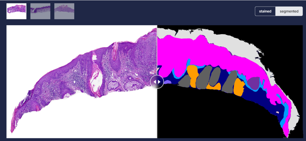 Figure 2: Real time staining of unstained whole slide image followed by analysis available at dermavision.ai