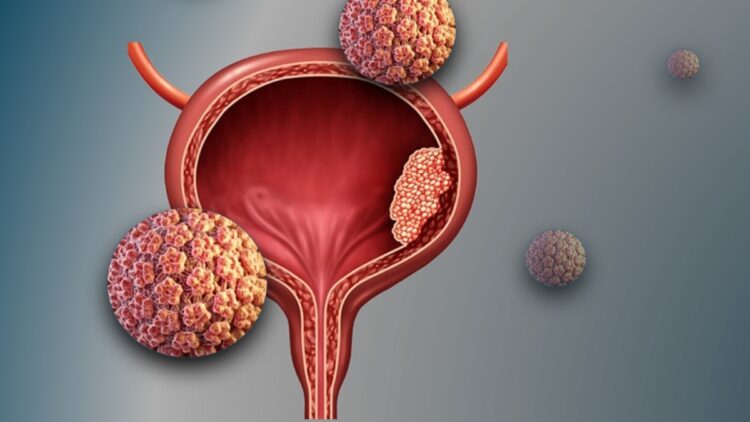 Human Papillomavirus (HPV) and Bladder Cancer