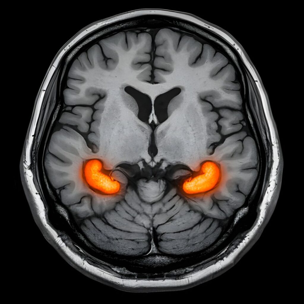 Figure 1: MRI scan showing hippocampus highlighted