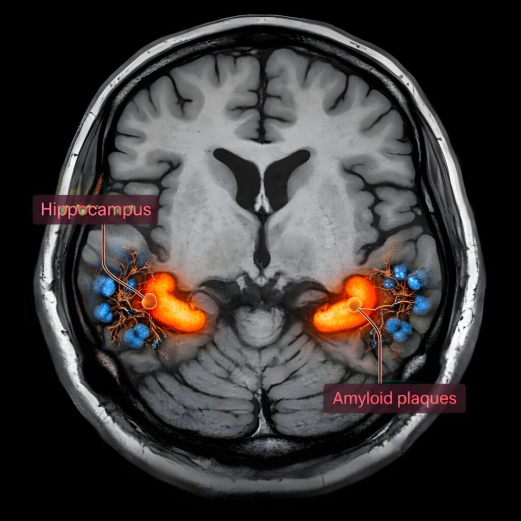 Figure 2: The hippocampus, one of the first brain regions affected by Alzheimer's disease